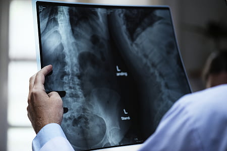 person holding an X-ray photo