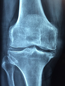 bone X-ray result