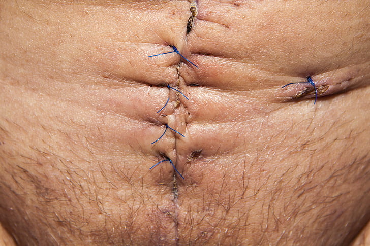 closeup of human's tummy with stitches